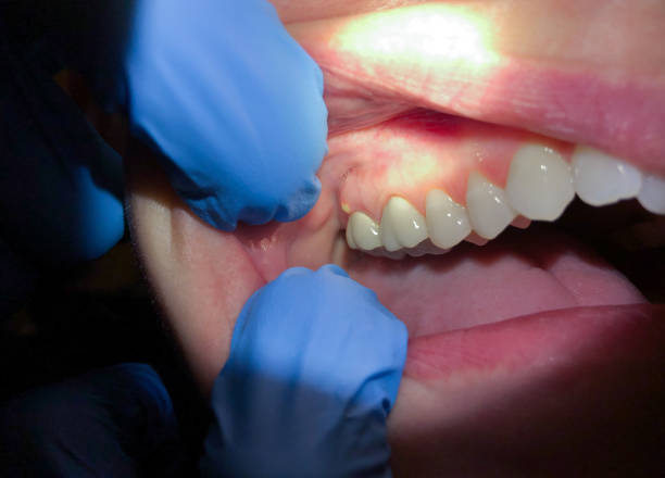Best Emergency Root Canal Treatment in Machesney Park, IL
